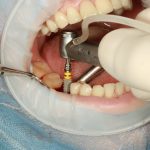 dental implant surgery