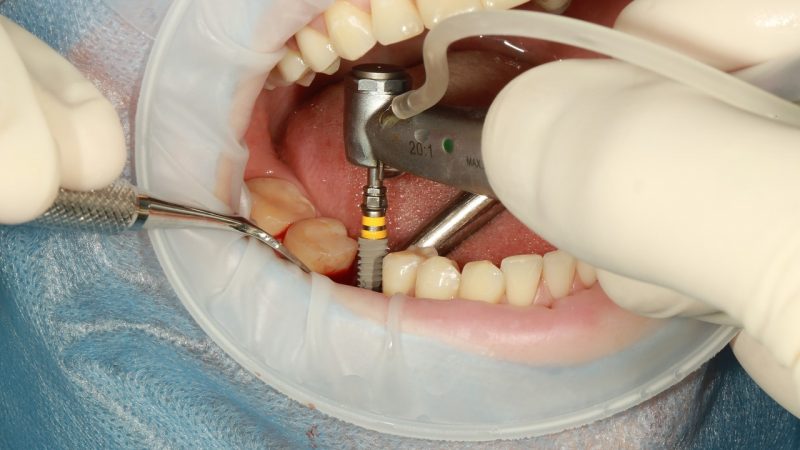 Top Benefits of Dental Implants