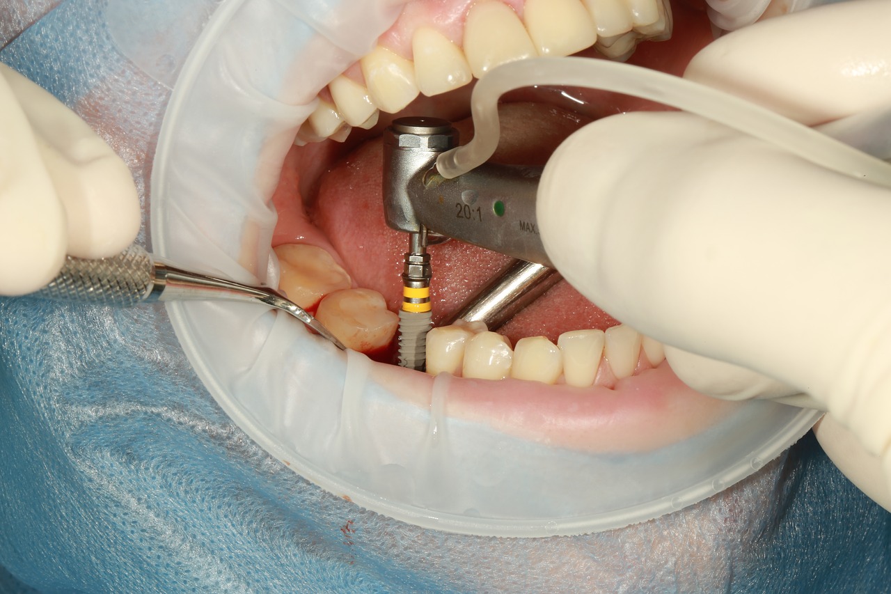 Top Benefits of Dental Implants