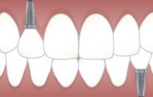 dental implants